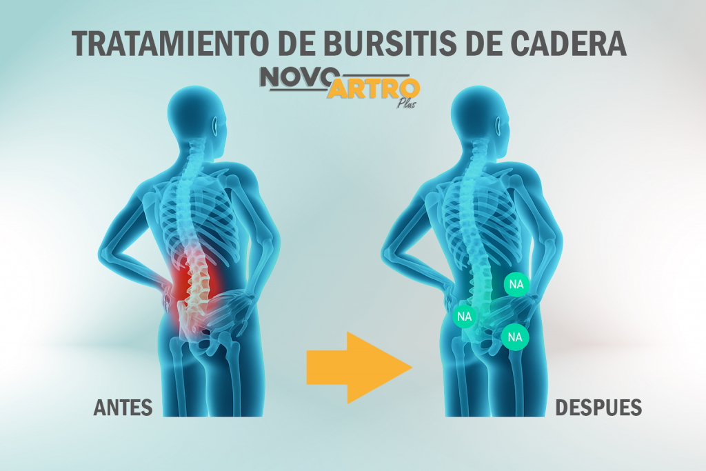 BURSITIS CADERA