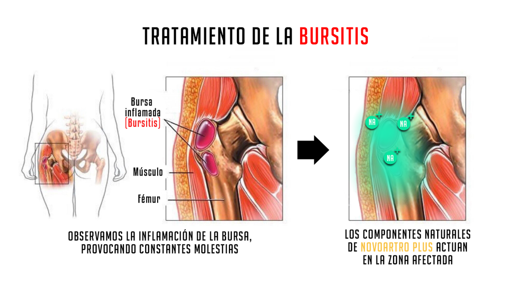 BURSITIS tecnica