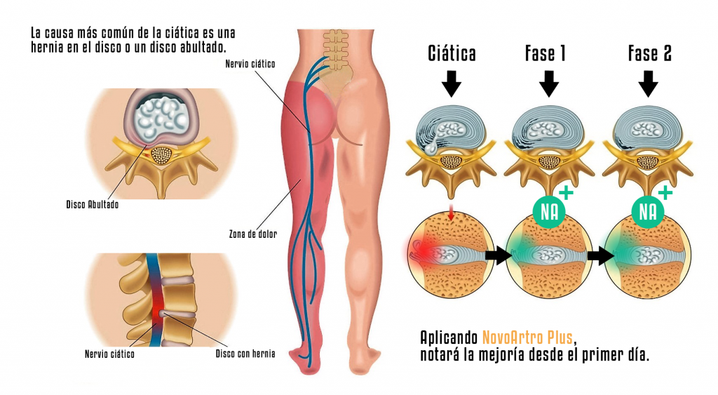 CIATICA TECNICA NOVOHAIR