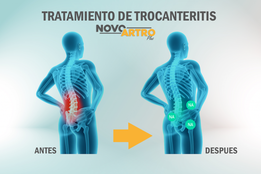 TROCANTERITIS PORTADA