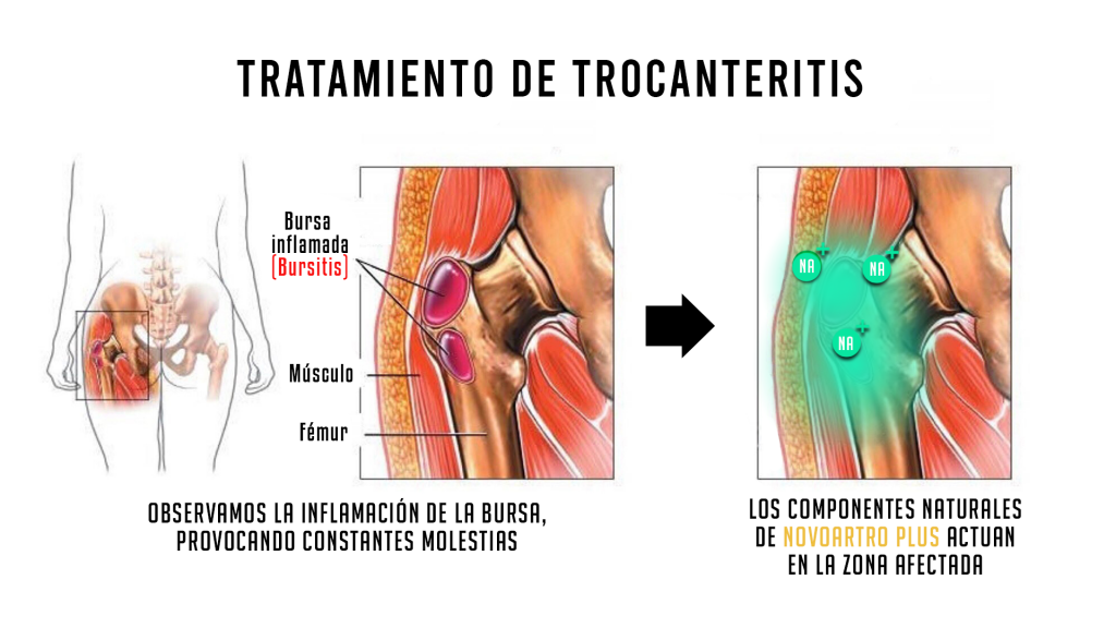 TROCANTERITIS tecnica